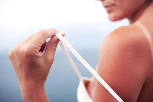 woman in bathing suit shows sunburn skin