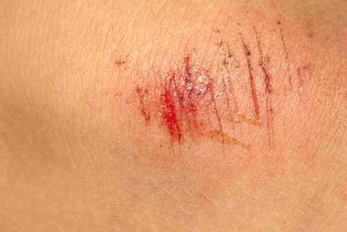 a bleeding scrap on an elbow