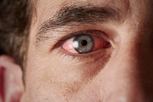 man with allergies has bloodshot eyes