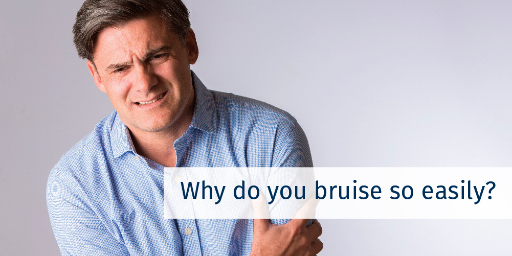 Why do you bruise so easily? Surprising reasons you are susceptible to